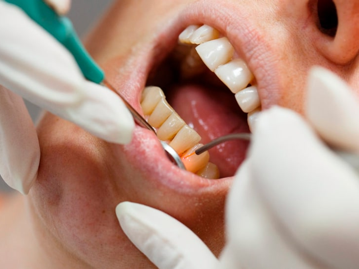 Имплантация зубов при пародонтозе