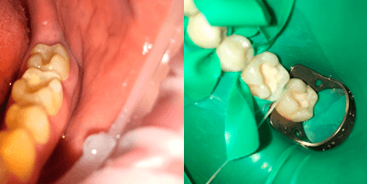 Фото до и после реставрации передних зубов композитами