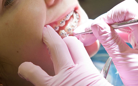 Кариес у детей: что нужно знать