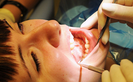 Что такое альвеолит зуба