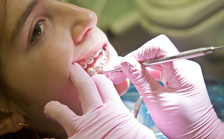 Как ухаживать за брекетами