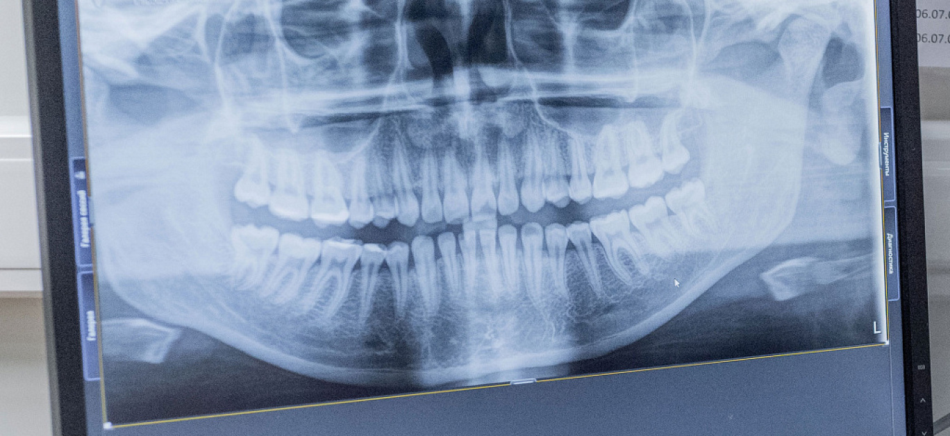 Аутотрансплантация зуба